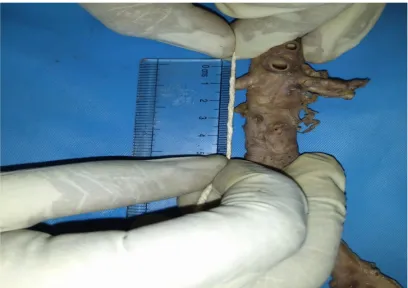 Fig 10 : Measuring the angle of the abdominal aorta using a protractor 