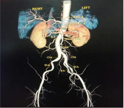 Fig no 11 : Radiological image of abdominal aorta. 