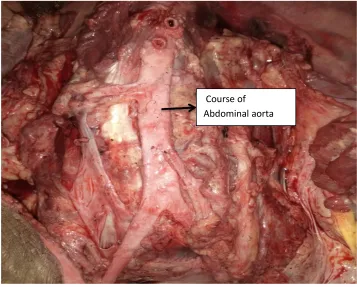 Fig 12 -Course of Abdominal aorta 