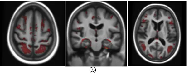 Fig. 3.GroupWise registration of all subjects comparing the (a) MRI-based approach (b) to the multistructure approach