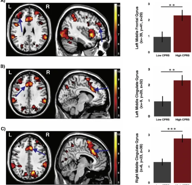 Fig. 2. Results of the region of interest analysis during failed stopping, showing A) increased left middle frontal gyrus activation in the high CPRS-R group compared to the low CPRS-R group, B) increased left middle cingulate gyrus activation in the high 