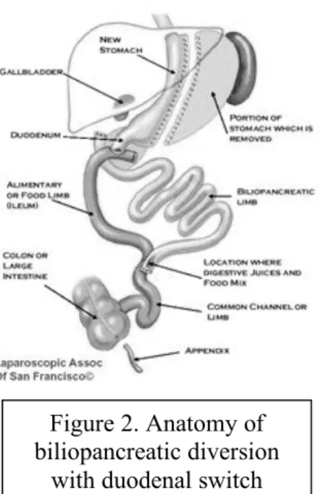 Figure 2. Anatomy of  biliopancreatic diversion 