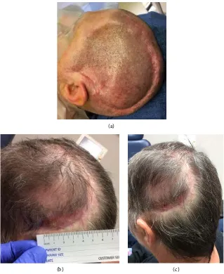 Figure 3. Photograph of recovering threatened ischemic cranial flap (a) six week; (b) Three months; and (c) six months after completing HBOT