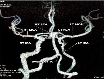 Fig 20.: Left fetal origin of posterior cerebral artery. 