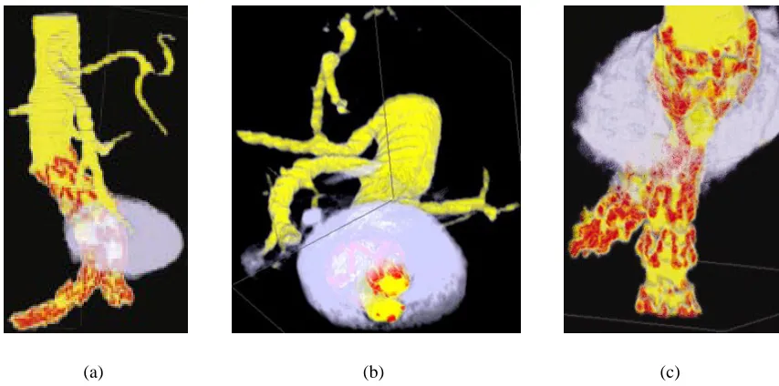 Figure 2.1: An abdominal aortic aneurysm visualized with different colourmaps and viewing directions: (a) ananeurysm visualized using a perceptual colourmap; (b) a cut through the volume created with Volren’s interactiveclip planes, showing the cross-sectional area of the aneurysm and the two iliac arteries, and the location of tynes(metal hooks) in a stent used to reinforce the artery wall; (c) an orthogonal viewing direction, showing clearly thelocation of the tynes in the vertical iliac artery.