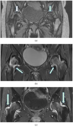 Figure 1. (a)-(c) Magnetic resonance images (MRI) of the pelvis showing a diffuse and bilateral epi- and metaphyseal bone marrow edema of the head and neck of femur and less pronounced in the acetabulum on the left side, a sclerotic area of 11 mm in the po