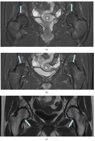Figure 2. (a)-(c) A repeated MRI 5 months postpartum shows a complete remission of the bone marrow edema in both proximal femurs with now correct bone marrow signal
