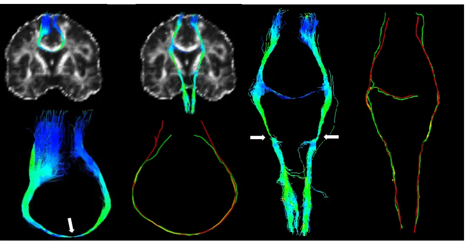 Figure 3. Bayesian tracking results from the seed point placed in the corpus callosum (left) and wild bootstrap results from two seed points (white arrows) in the corticospinal tract (right)