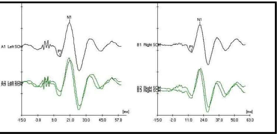 FIG 8: VEMP GRAPH 