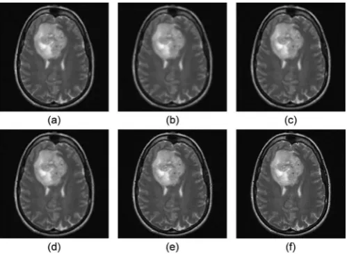 Figure 6. Representative reconstructed high-resolution T1-weighted images. (a) nearest neighbor, (b) bilinear, (c) bicubic, (d) Lanczos, (e) sparse-coding super-resolution, and (f) original region (ground-truth) image