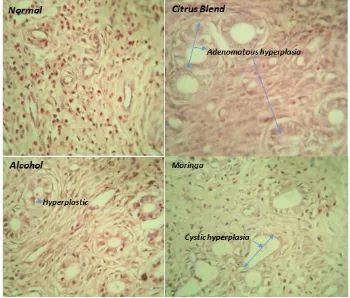 Fig. 3.The slide labelled Citrus Blend shows Adenomatous hyperplasia of the endometrial glands