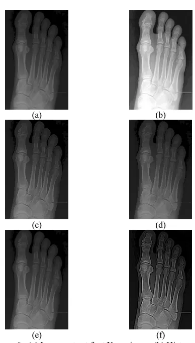 Figure 6 - (a) Low-contrast foot X-ray image (b) Histogram 