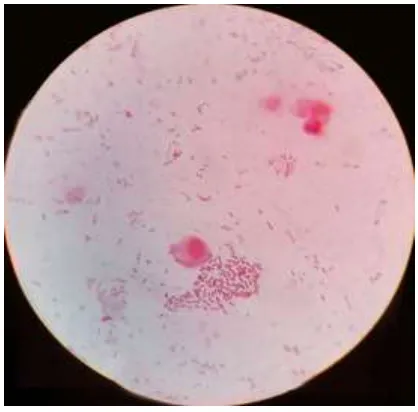 Figure 5b: Gram stain showing Gram negative bacilli 