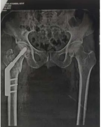 Figure 18:  Fracture Tibia with Open Wound 