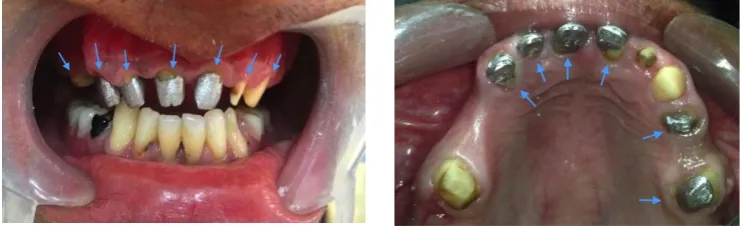 Fig. 16. (A) Special trays  (B) Final impressions   