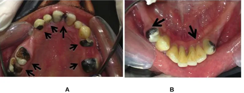 Fig. 3. (A) Extensively decayed teeth # 11, 12, 13, 16, 17, 21, 24, 26 (B) 33 and 44   
