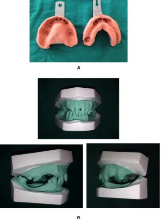 Fig. 4. (A) Upper and lower arch impressions in alginate and (B) Pre-operative models to study  occlusion  