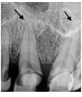Fig. 5. Pre- operative radiograph of  tooth # 11and 21 