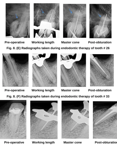 Fig. 8. (G) Radiographs taken during endodontic therapy of tooth # 44   