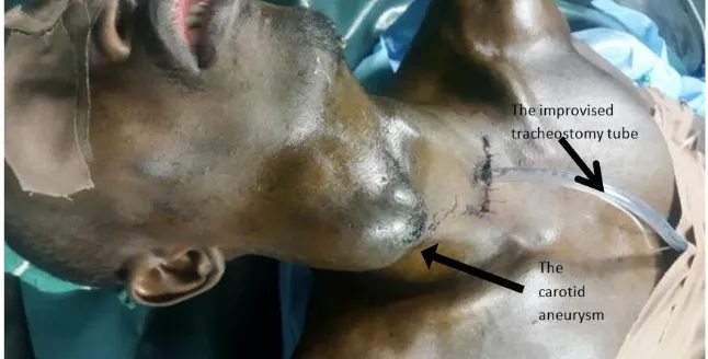 Fig. 1. Showing the aneurysm and the tracheostomy tube in-situ pre-operatively 