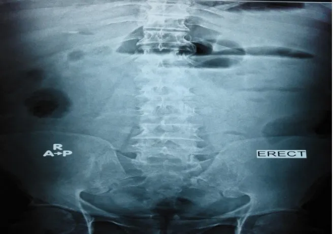 Fig. 1. Abdominal X-ray 