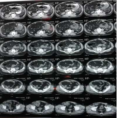Fig. 2. CT abdomen   
