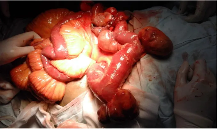 Fig. 4. Multiple giant jejunal diverticula 