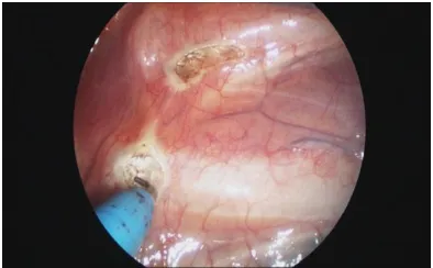 Fig. 2. Dividing communicating branches using cautery 