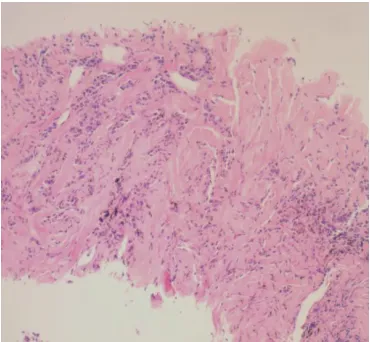 Fig. 3 A. H&E 100x- chronic inflammation and hyalinized fibrous tissue 