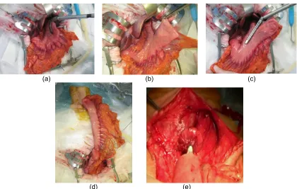 Fig. 1a. Postlethwait method; After opening a small hole in the antrum with circular stapler 3 to 