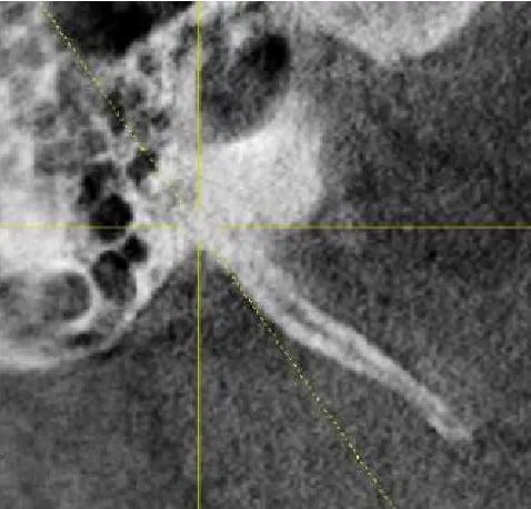 Fig. 5. Type A Calcification (Calcified outline) 
