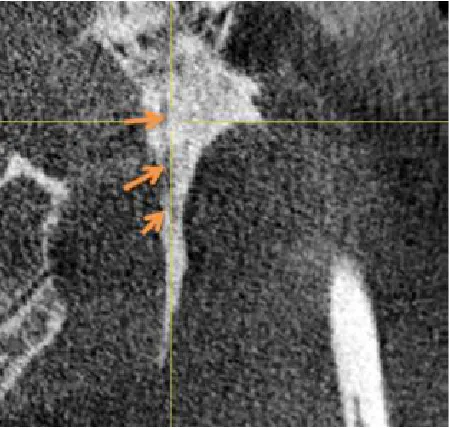 Fig. 6. Type B Calcification (Partially calcified with discontinuous radiolucent core)   