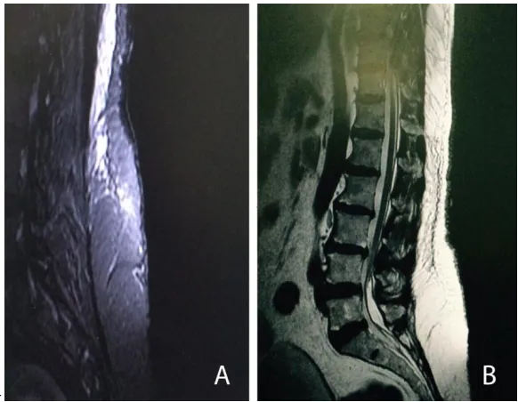 Fig. 1. T2 MRI shows L4 tethered cord  
