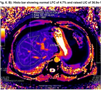 Fig. 6. C): Corrected T1 map Corrected T1 map of 642 msec in a patient of DIOS 
