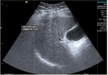 Fig. 3. C): T1 parametric map of liver showing T1 shortening of 538 msec in group I patient.T1 parametric map of liver showing T1 shortening of 538 msec in group I patient