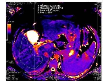 Fig. 4. B): Group III same patient showing Normal LFCGroup III same patient showing Normal LFC of 1.9% and normal LIC of 21.1 s of 1.9% and normal LIC of 21.1 s-1 