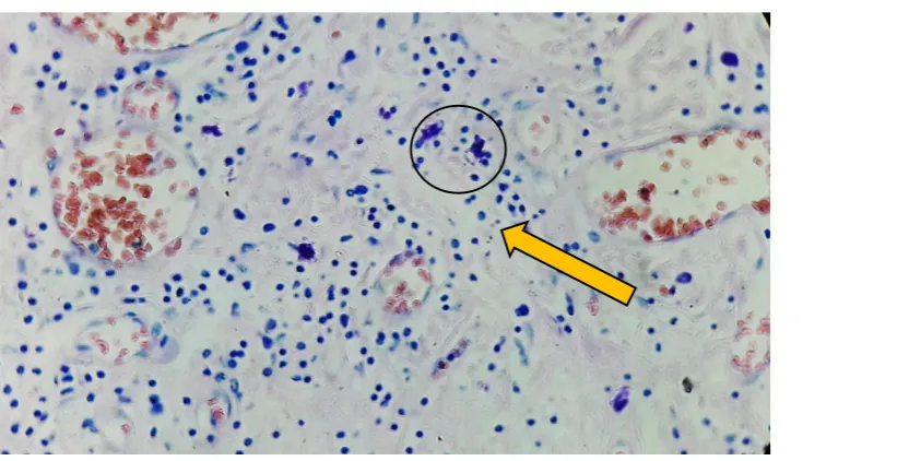 FIGURE 3.IMMUNOHISTOCHEMISTRY OF HER 2 NEU 