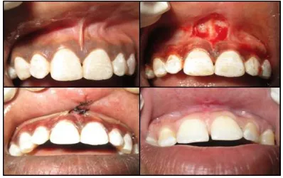 Fig. 1. Frenectomy is carried out with help of scalpel 