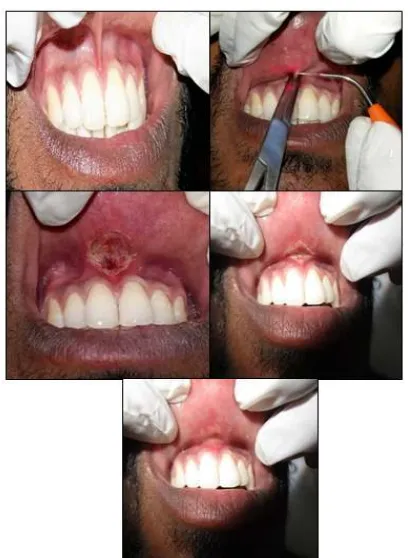 Fig. 2. Frenectomy is carried out with help of electrocautery 