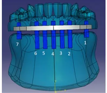 Fig. 1. Three-dimensional (3-D) CAD mandible  model including implants, abutments, and the 