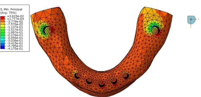 Fig. 5. Occlusal view of the 3-D mesh. CG stresses on the bone surface: minimum principal stresses