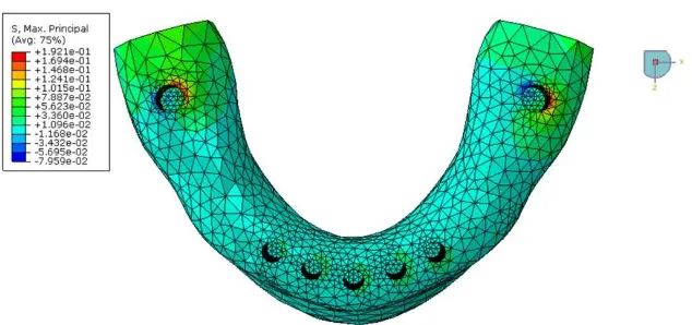Fig. 8. Occlusal view of the 3-D mesh. BBO stresses on the bone surface: minimum principal  stresses