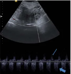 Figure 1. Saggital ultrasound image of uterus use concurrent color Dopp-ler demonstrates typical “ying-yang” sign at left adnexa characteristic for pseudoaneurysm (arrow), (U) uterus