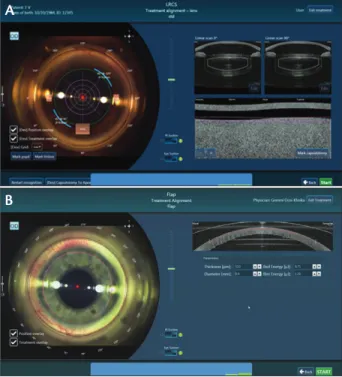 Figure 2.  Example of the cataract treatment planning screen  (A) and the flap treatment alignment screen of the Victus (B).
