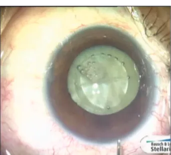 Figure 1.  Example of a white intumescent cataract. 
