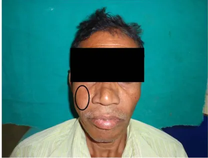 Fig. 1. Front profile of the patient showing  swelling on the right side of middle 1/3rd of 