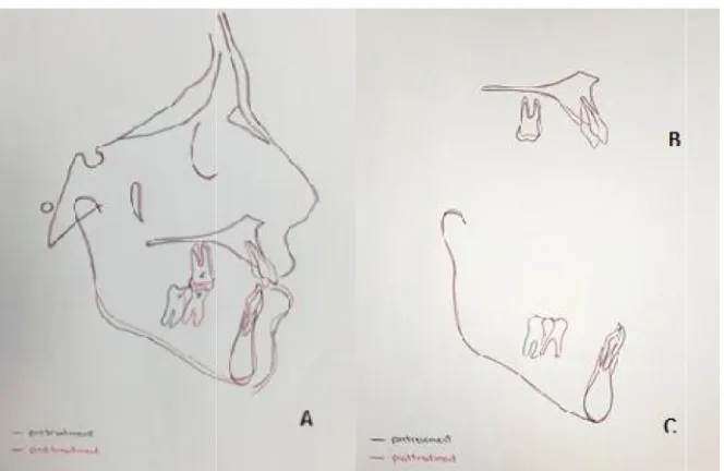 Fig. 5. (A) Postactive treatment cephalograph. (B) Tracing. (C) Panoramic radiographFig