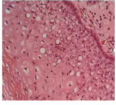 Fig. 2. H & E 100 X: The slide of the ectocervical region showing plenty of signet 