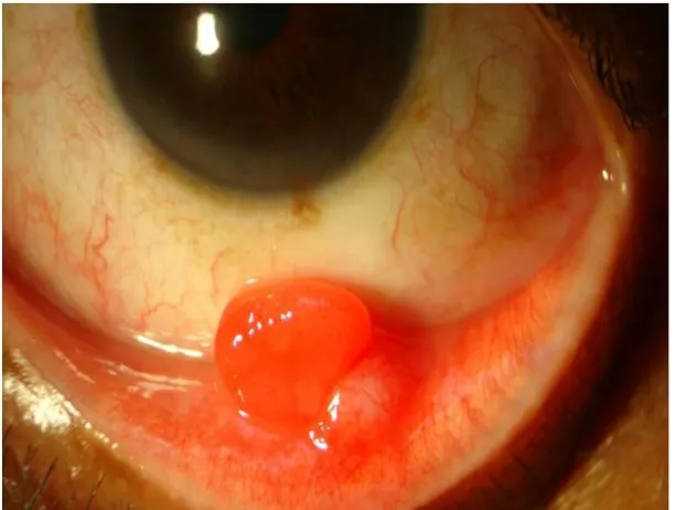 FIGURE 9a: PYOGENIC GRANULOMA – GROSS AND HISTOPATHOLOGICAL 