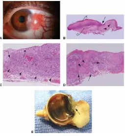 FIGURE 24: OSSN – GROSS AND HISTOPATHOLOGICAL IMAGE 